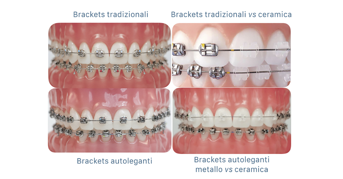 Apparecchi ortodontici - Panoramica dei diversi tipi